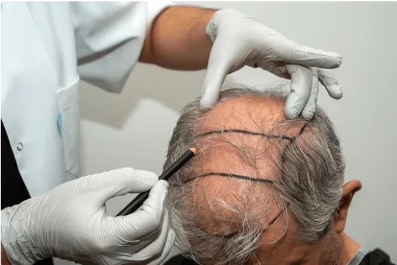 Cirugía capilar en Málaga: Restauración segura y natural del cabello